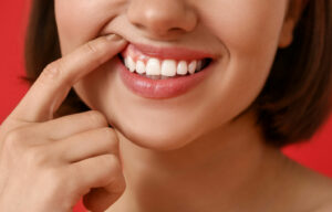 gummy smile