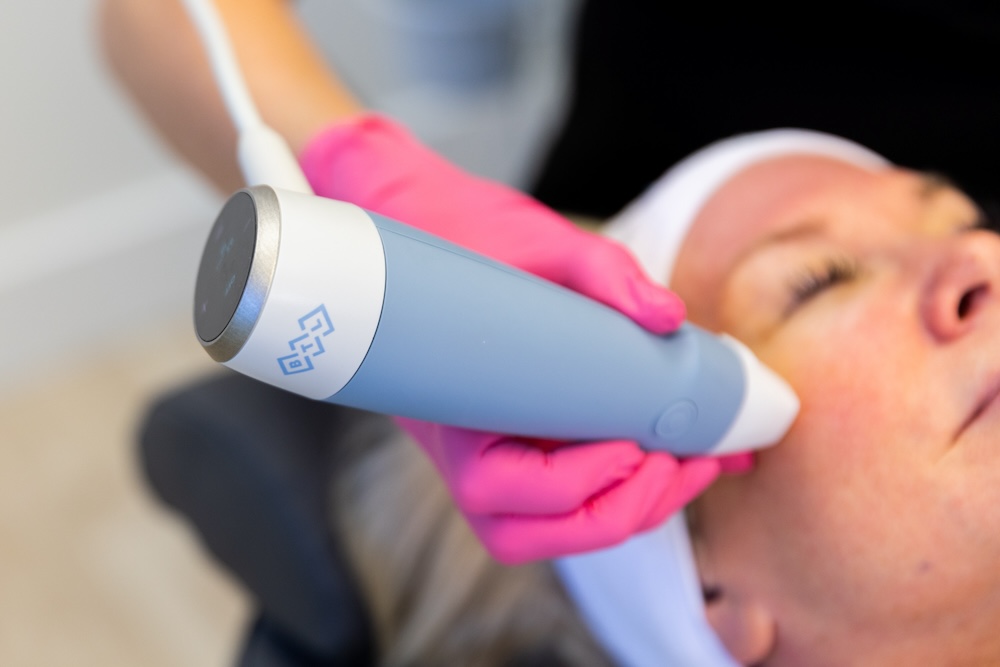 Provider places device for RF microneedling near Weddington on patient's cheek to rejuvenate her skin.