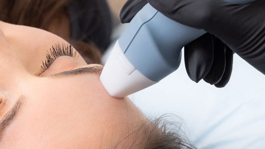 Woman laying down with eyes closed asa provider places the handheld device for RF microneedling near Weddington on her forehead
